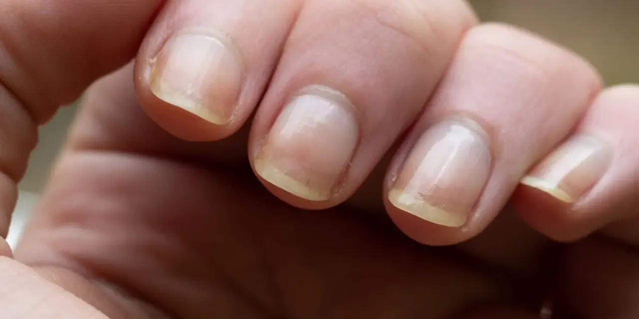Gros plan sur des doigts montrant un ongle jaune, signe possible d'une mycose ou d'une autre affection.