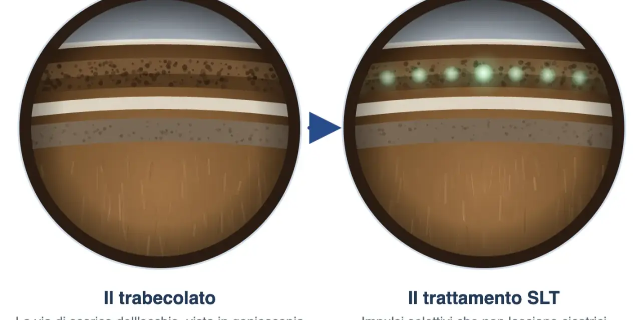 Trabeculoplastica laser selettiva: prima e dopo il trattamento SLT. Impulsi laser che migliorano il drenaggio oculare, minimizzando i rischi di cicatrici.