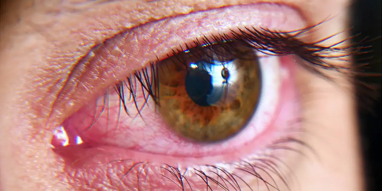 Occhio arrossato e irritato, possibile sintomo di sindrome dell'occhio secco cause.