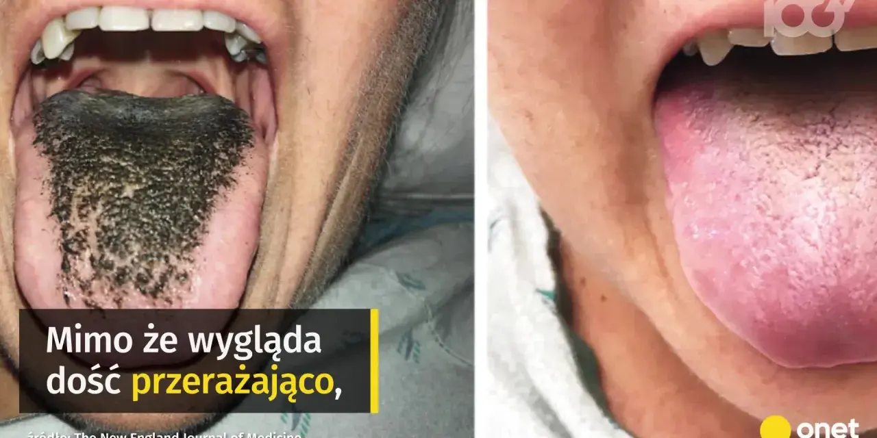 Czarny język pokryty ciemnymi włoskami, wyglądający niepokojąco, ale niegroźnie. Obok zdrowy, różowy język.