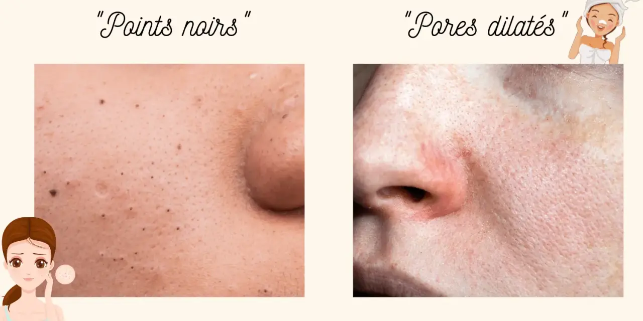 Gros plan sur la peau : points noirs d'un côté, et de l'autre, une zone avec des pores dilatés, suggérant un traitement.