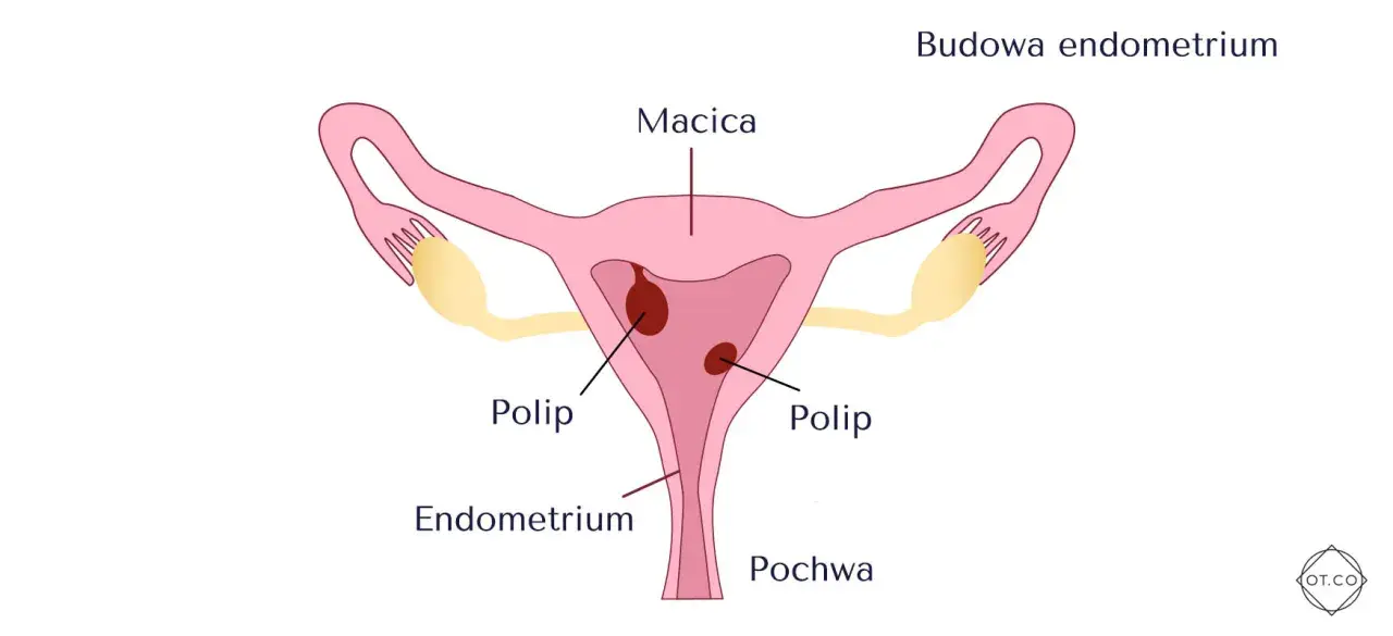Ilustracja przedstawia budowę macicy z widocznymi polipami w endometrium.