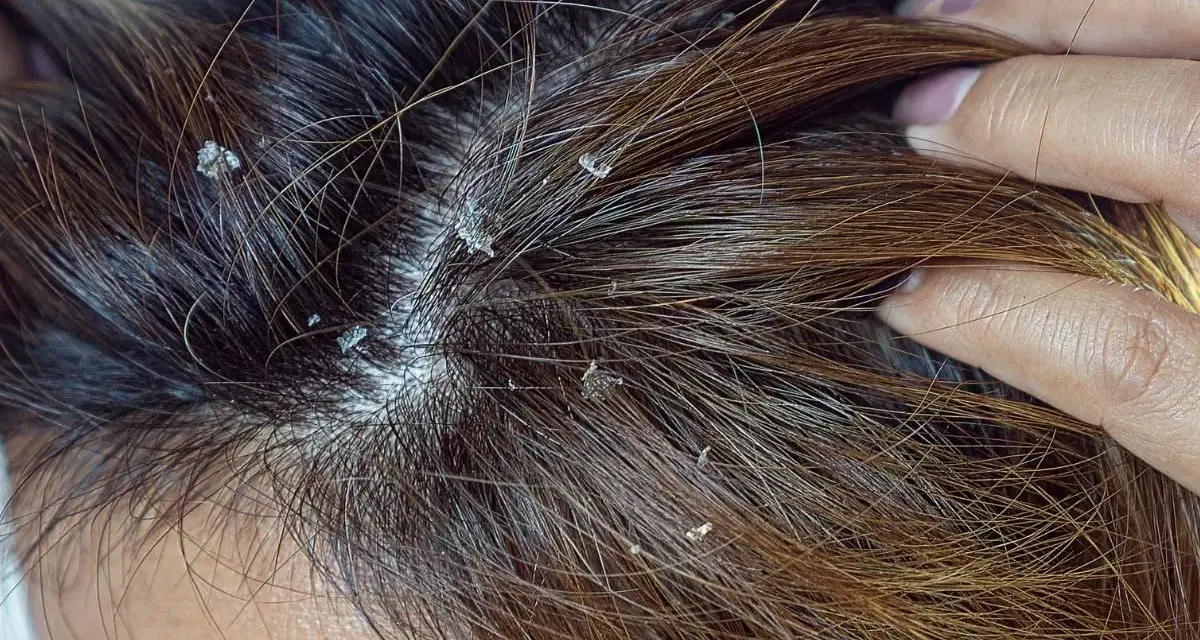 Widoczne białe płatki na ciemnych włosach. Czy to łupież? Dowiedz się, dandruff co to jest i jak sobie z nim radzić.