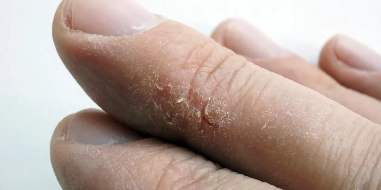 Gros plan sur des doigts aux bouts secs, la peau craquelée et desquamée.