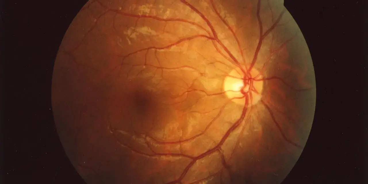 Il fundus oculi cos'è? Un'immagine della retina con vasi sanguigni rossi e aree biancastre, rivelando la sua complessa struttura interna.