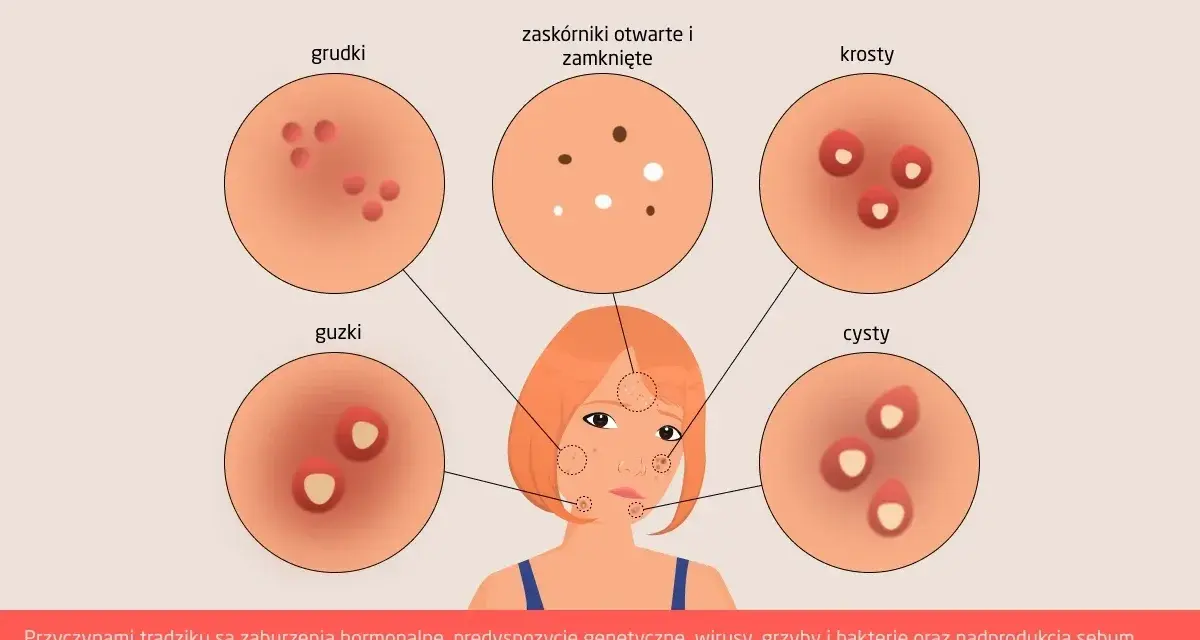 Ilustracja przedstawia różne rodzaje trądziku: grudki, zaskórniki, krosty, guzki i cysty.