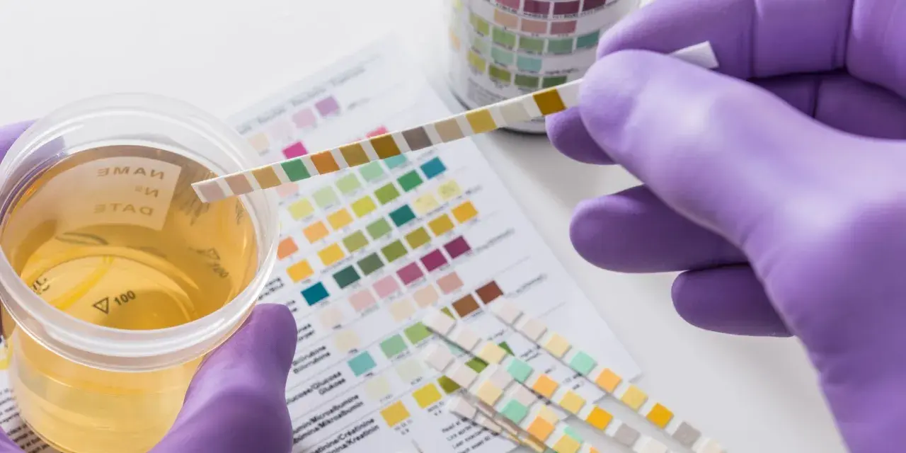 Urinprobe mit Teststreifen zur Analyse. Mögliche erhöhte Leukocyten im Urin werden durch Farbveränderungen auf dem Teststreifen angezeigt.