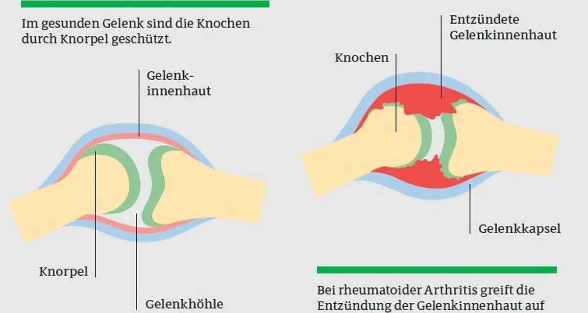Die häufigsten Symptome der rheumatoiden Arthritis und ihre Folgen