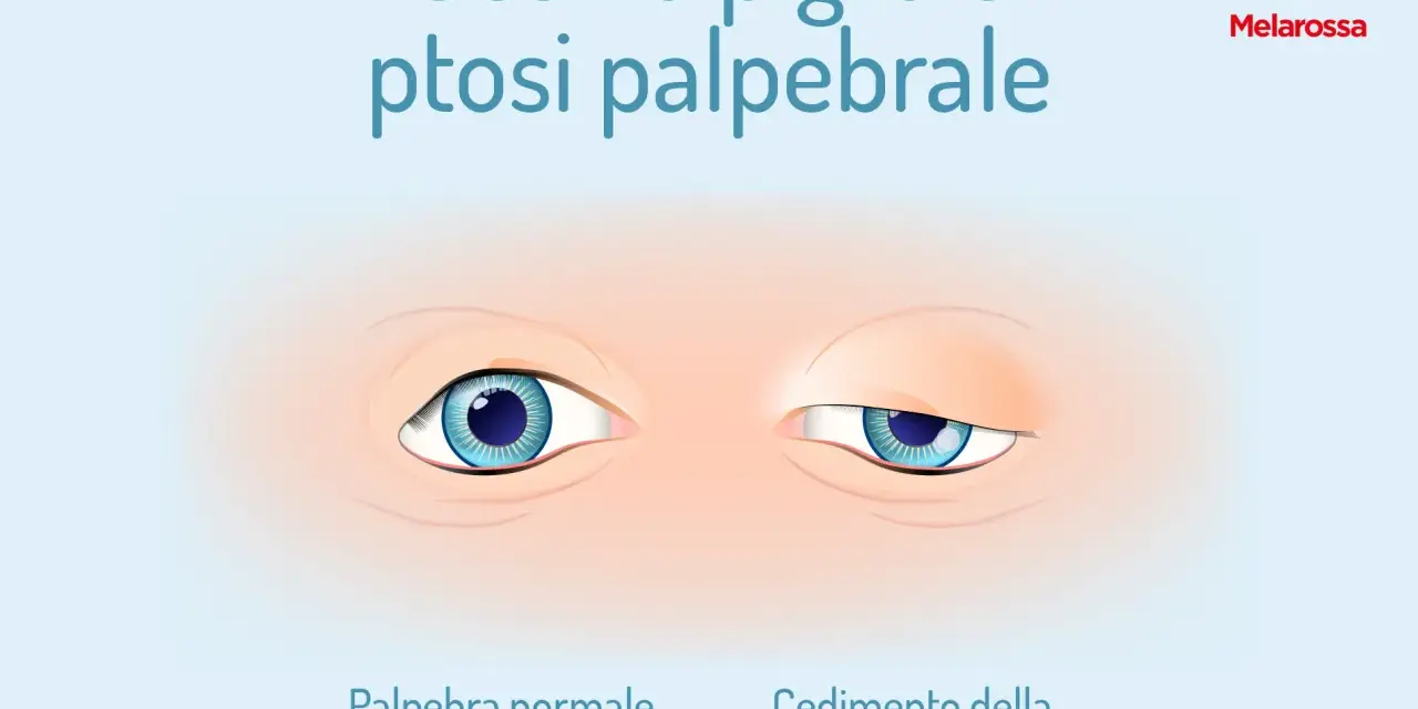Occhio pigro e ptosi: confronto tra palpebra normale e cedimento. Ambliope cosa significa?