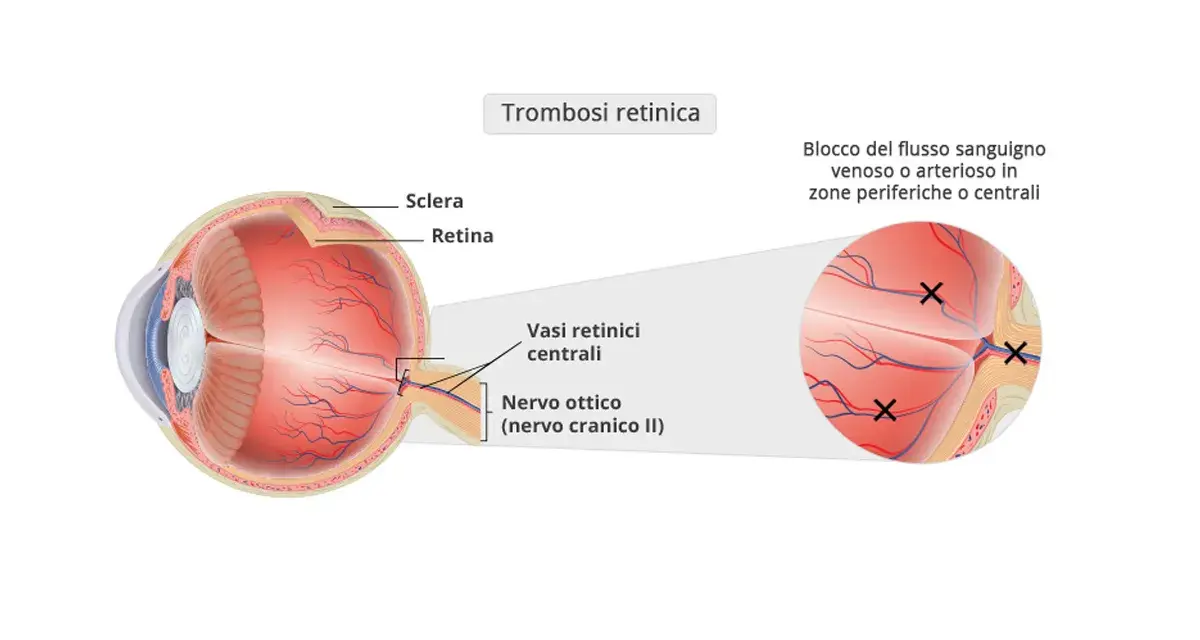 Diagramma occhio: trombosi retinica con blocco flusso sanguigno. Sintomi visivi possono manifestarsi in zone periferiche o centrali.