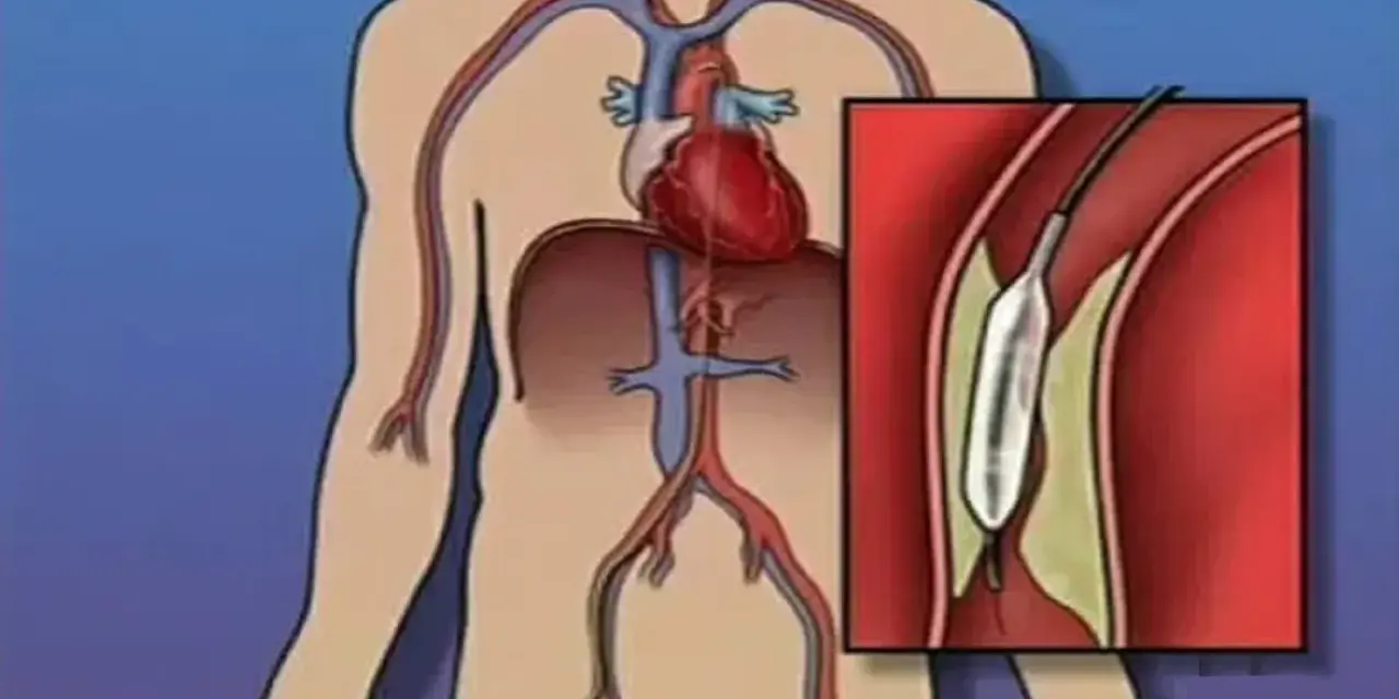 Ilustracja przedstawia serce i naczynia krwionośne z powiększeniem balonu w tętnicy.