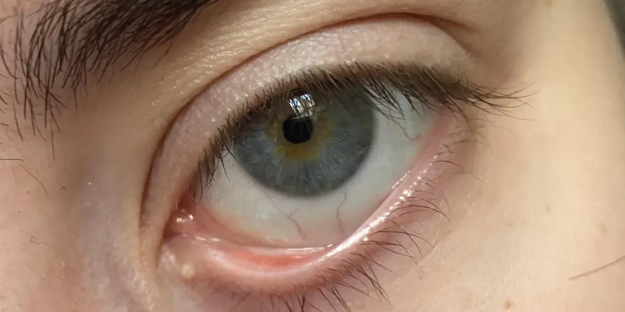 Ojo con milium en el contorno. Pequeños puntos blancos bajo la piel, un desafío para eliminar milium contorno ojos.