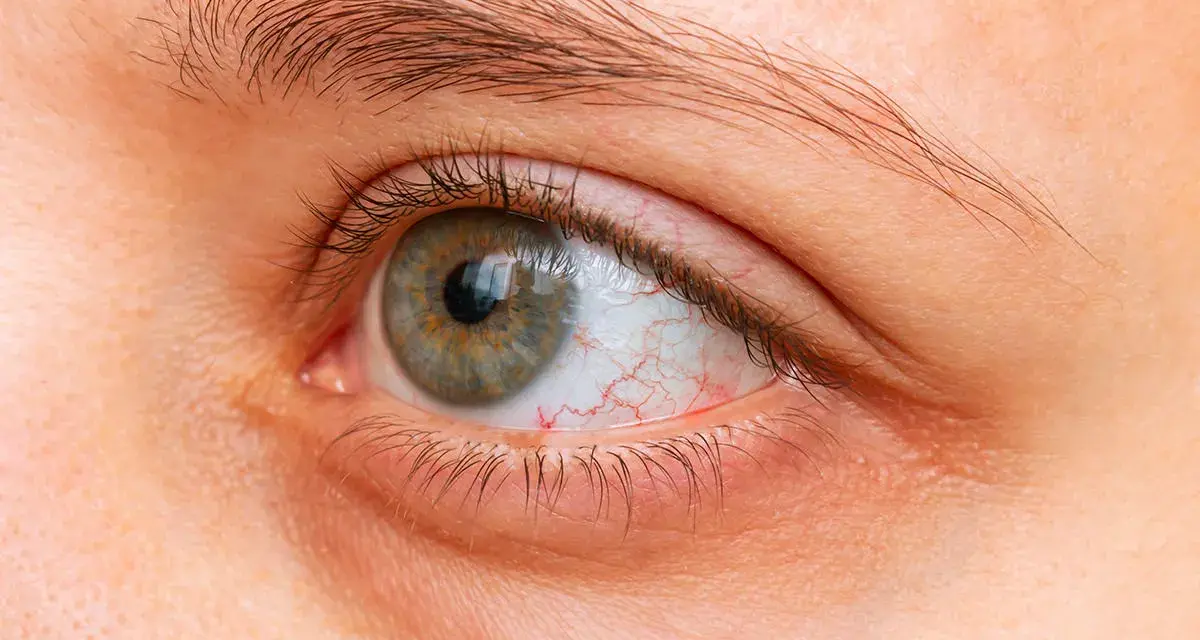 Occhi secchi di notte, con la sclera arrossata e capillari visibili. La palpebra inferiore appare leggermente gonfia.