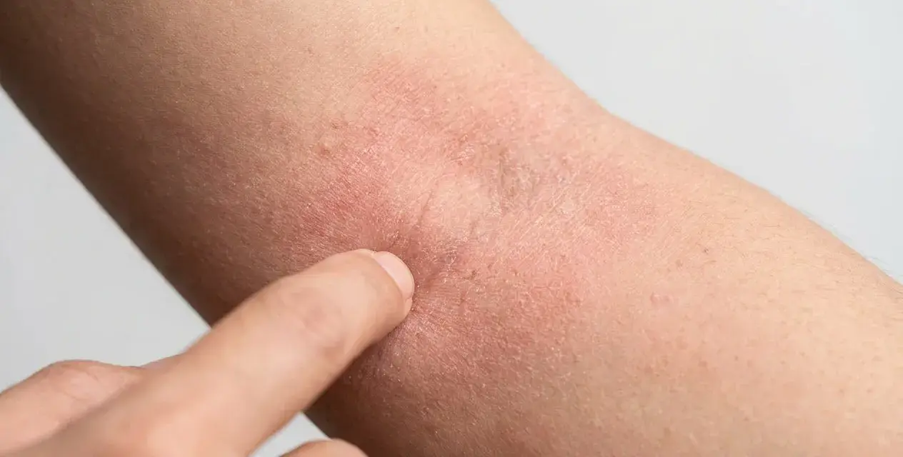 Rote, trockene Haut am Arm, die auf Neurodermitis hindeutet. Eine Hand berührt die betroffene Stelle, um zu zeigen, was hilft gegen Neurodermitis.