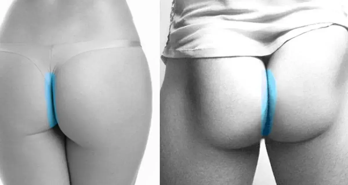 Dos imágenes comparan la depilación anal, una con ropa interior y otra sin ella, resaltando la zona con azul.