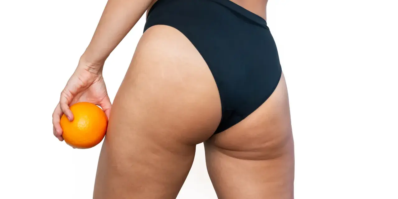 Mujer con naranja en mano, mostrando sus piernas y glúteos con celulitis. ¿Buscas como quitar celulitis piernas?
