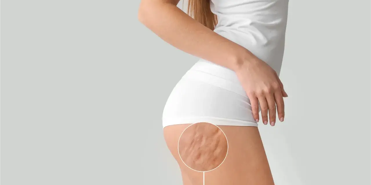 Nahaufnahme der Cellulite am Oberschenkel einer Frau. Hier wird gezeigt, was hilft gegen Cellulite.