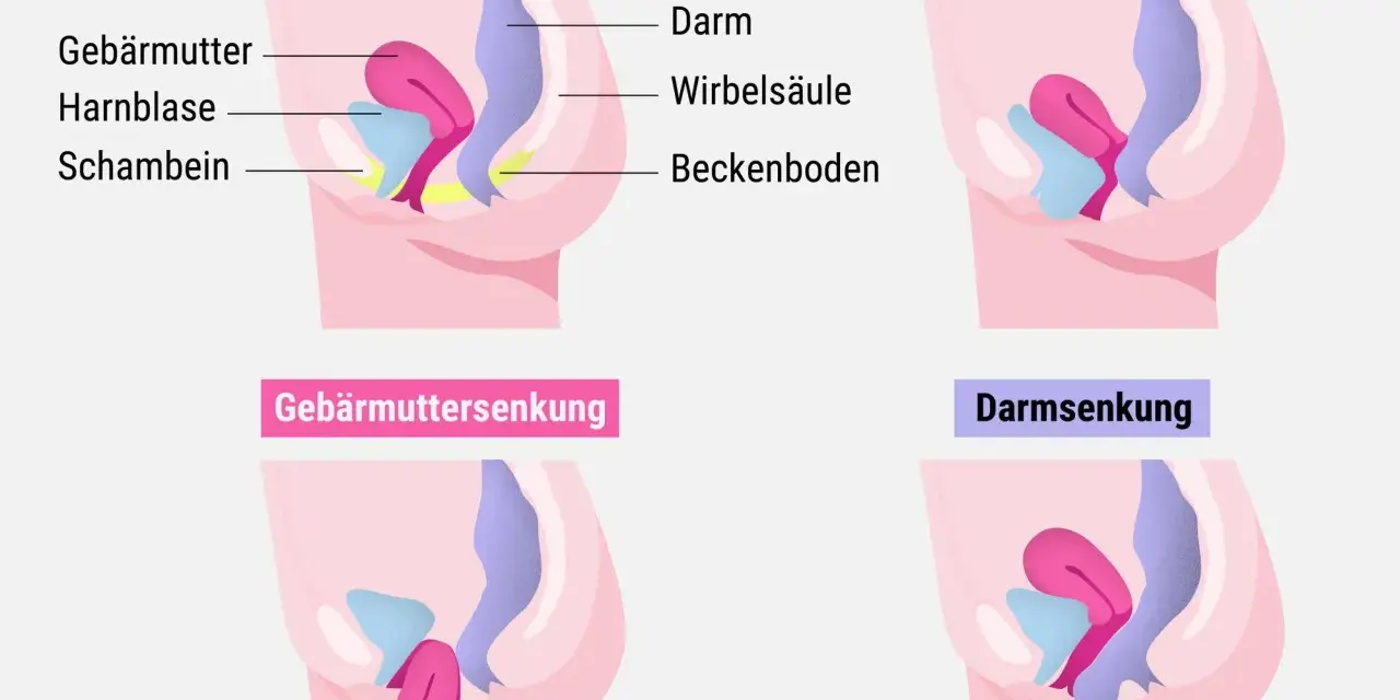 Schematische Darstellung des Beckenbodens: Normale Lage, Blasensenkung, Gebärmuttersenkung und Darmsenksung nach der Geburt.