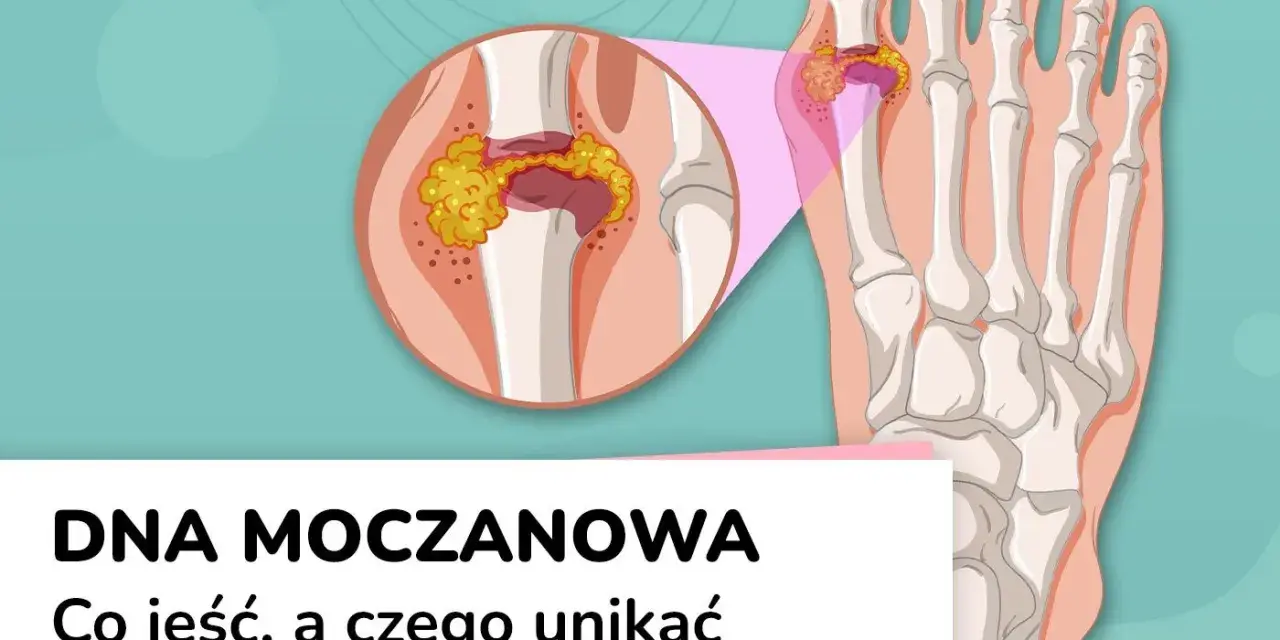 Dna moczanowa: powiększony staw palucha z kryształkami kwasu moczowego. Objawy dny moczanowej mogą być bolesne.