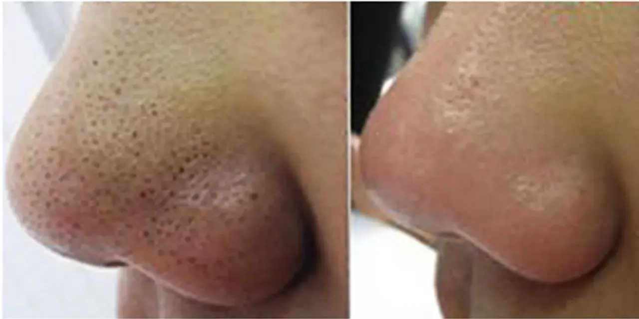 Nariz con puntos negros antes y después de un tratamiento para como quitar los puntos negro de la nariz.
