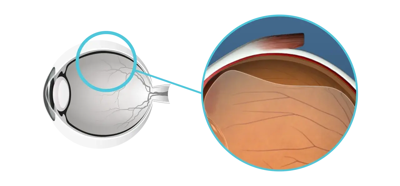 Illustrazione anatomica dell'occhio che mostra il distacco posteriore di vitreo, cosa significa questa condizione.