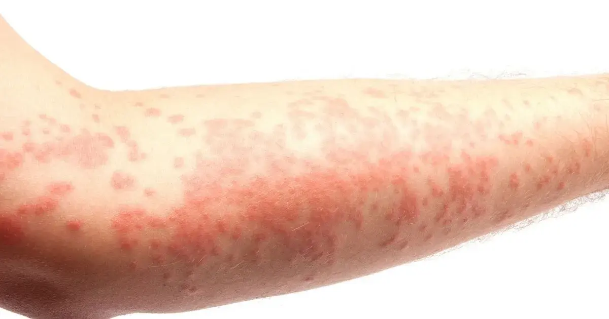 Alergia na sierść: objawy skórne, które mogą zaskoczyć każdego