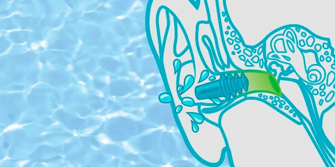 Illustration zeigt ein Kind, das Wasser im Ohr hat. Ein Stöpsel schützt das Ohr vor weiterer Flüssigkeit.