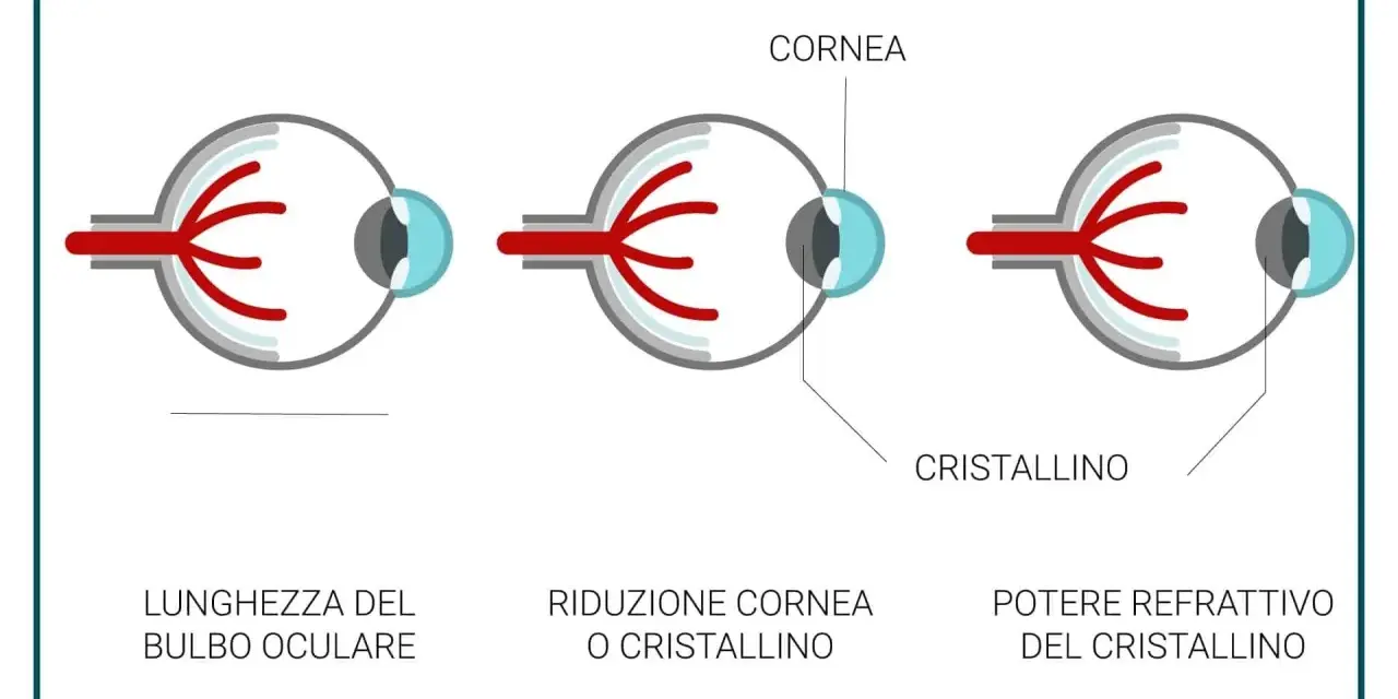 Illustrazione delle cause dell'ipermetropia: bulbo oculare corto, cornea o cristallino ridotti, o potere refrattivo del cristallino.
