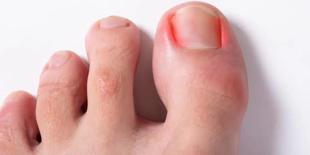 Wrastający paznokieć: Jak szybko złagodzić ból i kiedy do podologa?