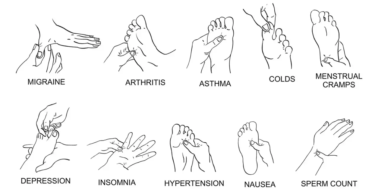 Illustration zeigt akupressur druckpunkte für Migräne, Arthritis, Asthma, Erkältungen, Menstruationsbeschwerden, Depressionen, Schlaflosigkeit, Bluthochdruck, Übelkeit und Spermienzahl.