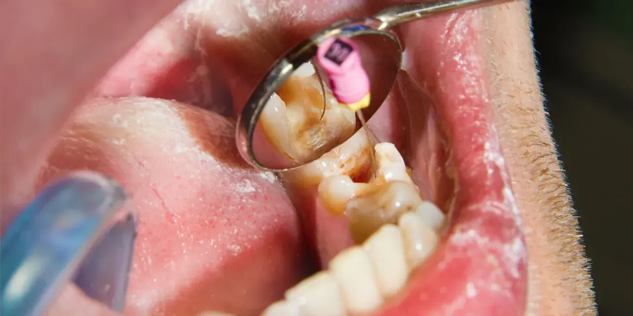 Dentysta podczas leczenia kanałowego zęba. W odbiciu lusterka widać narzędzie stomatologiczne i różowy kołeczek z oznaczeniem rozmiaru.