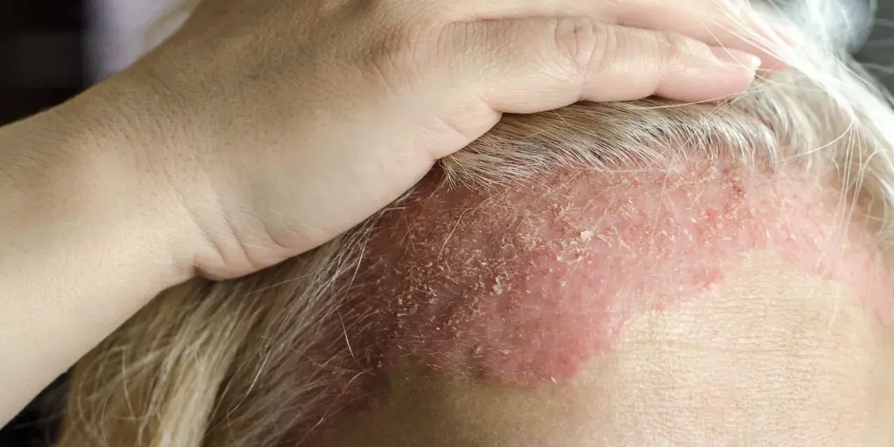 Dłoń dotyka czoła z zaczerwienioną skórą i łuszczącą się skorupą na głowie, wskazującą na problem dermatologiczny.