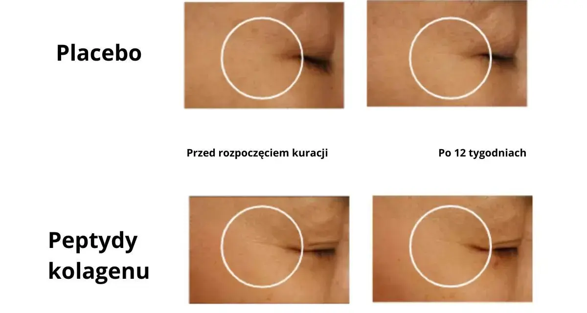 Porównanie efektów kolagenu do picia: skóra przed i po 12 tygodniach kuracji. Zmniejszenie zmarszczek wokół oka.