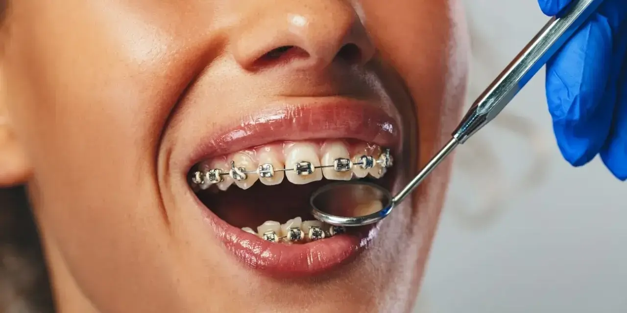 Uśmiechnięta twarz z widocznym aparatem stałym metalowym na zębach. Dentysta bada zęby lusterkiem.