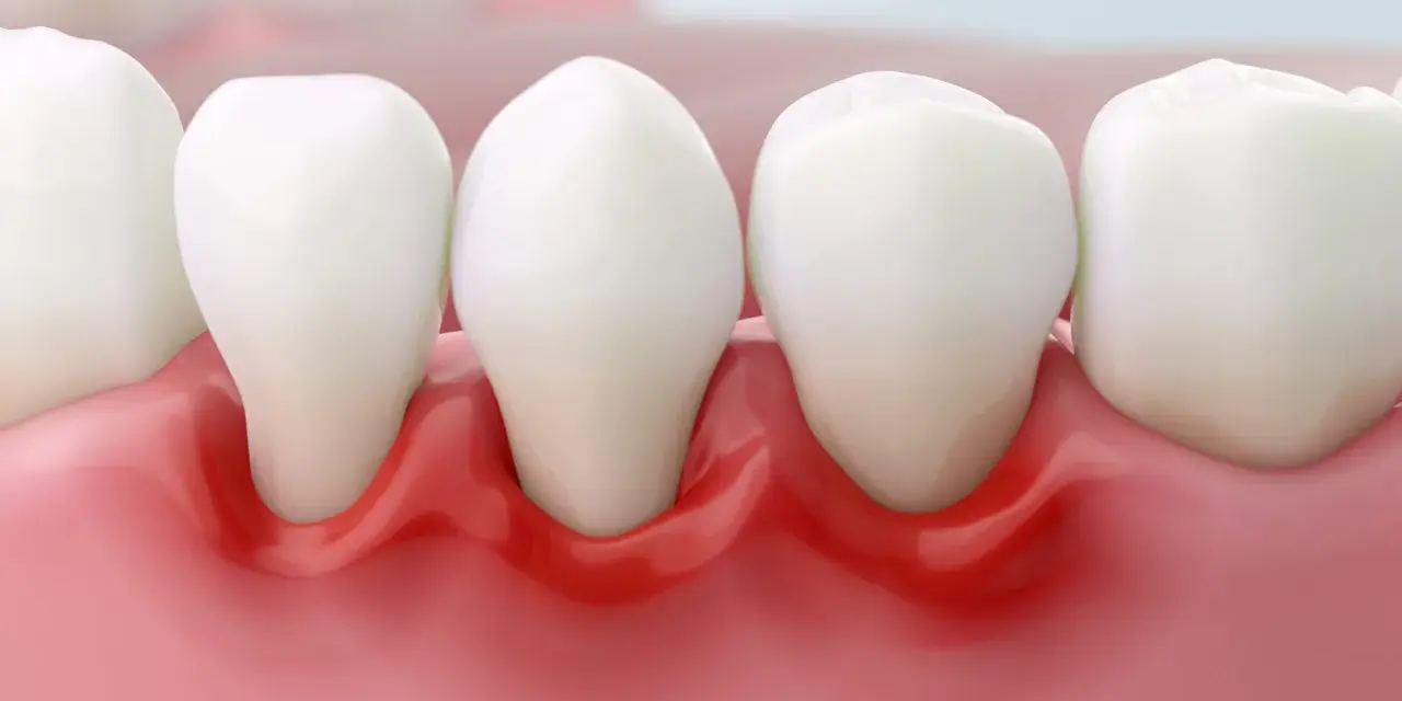 Podrażnione dziąsła: Szybka ulga, leczenie i kiedy do dentysty?