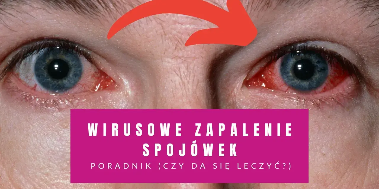 Czerwone, podrażnione oczy z czerwoną strzałką wskazującą na zapalenie. Poradnik: wirusowe zapalenie spojówek - jaki lek na zapalenie spojówek?