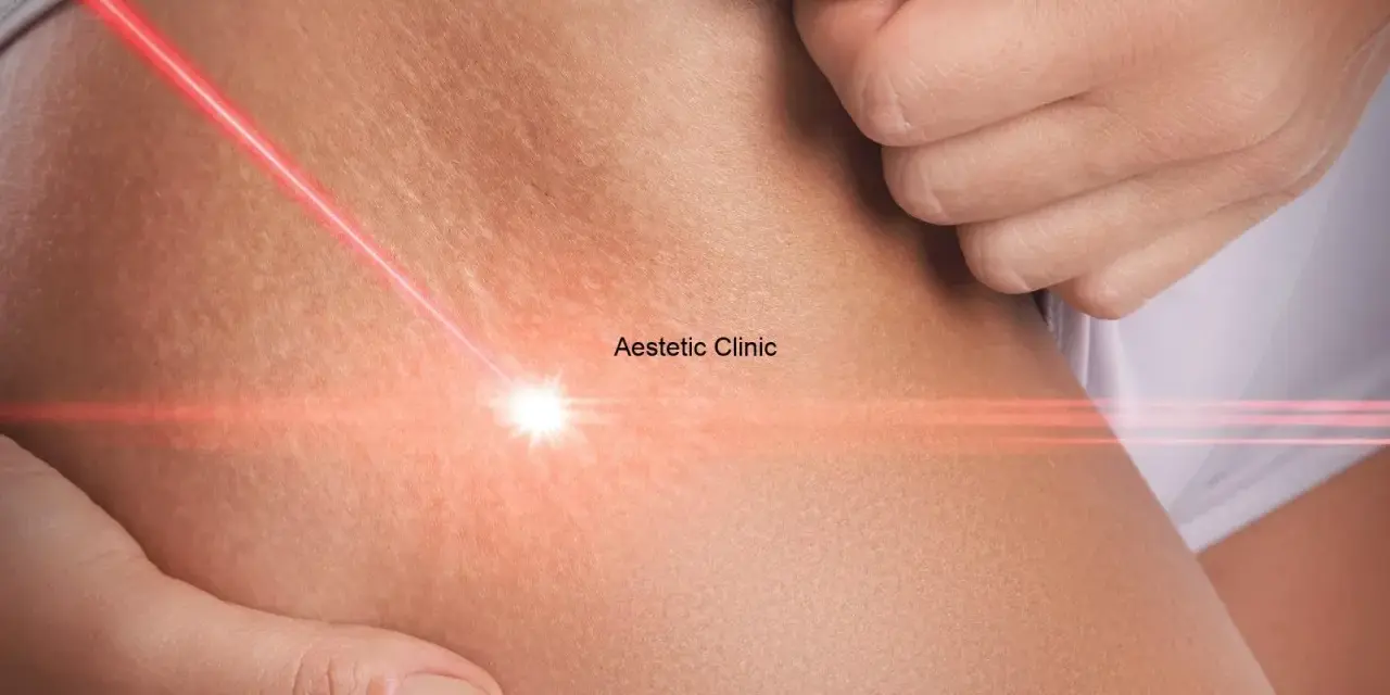 Czerwony promień lasera skierowany na rozstępy na biodrach, symbolizujący zabieg estetyczny.
