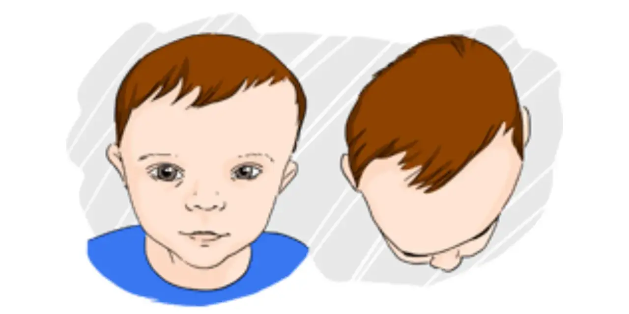 Ilustracja pokazuje niemowlaka z asymetrią główki, co może wskazywać na plagiocefalię.