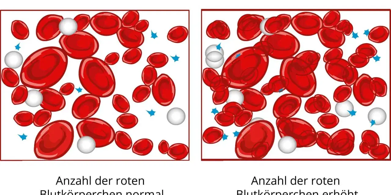 Vergleich von roten Blutkörperchen: Links normal, rechts erhöht (erythrozyten zu hoch). Polyglobulie durch Sauerstoffmangel.