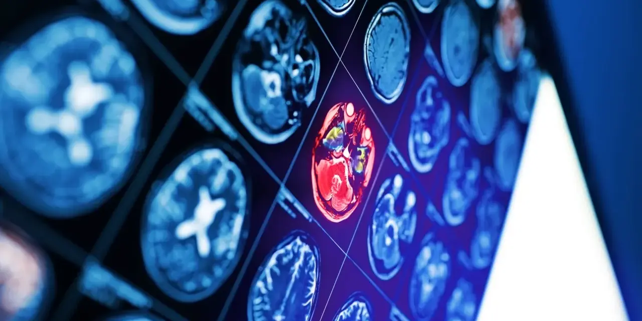 Sekwencja obrazów neurotop z wyróżnionym czerwonym obszarem mózgu, sugerującym nieprawidłowość.