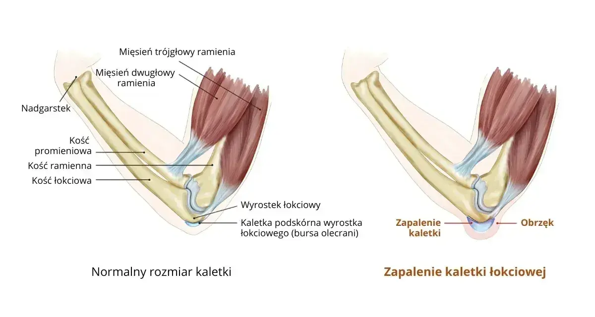 Porównanie zdrowej kaletki łokciowej z jej zapaleniem i obrzękiem. Ilustracja pokazuje anatomię łokcia i skutki zapalenia kaletki łokciowej.