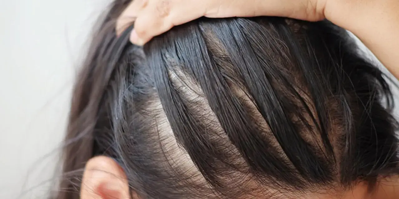 Nahaufnahme der Kopfhaut einer Person, die sich kratzt. Möglicherweise ein Anzeichen von Neurodermitis Kopfhaut.