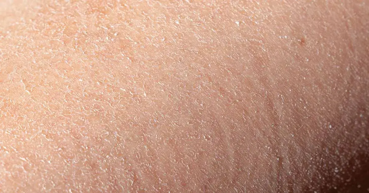 Ursachen und Lösungen für trockene schuppige Gesichtshaut verstehen