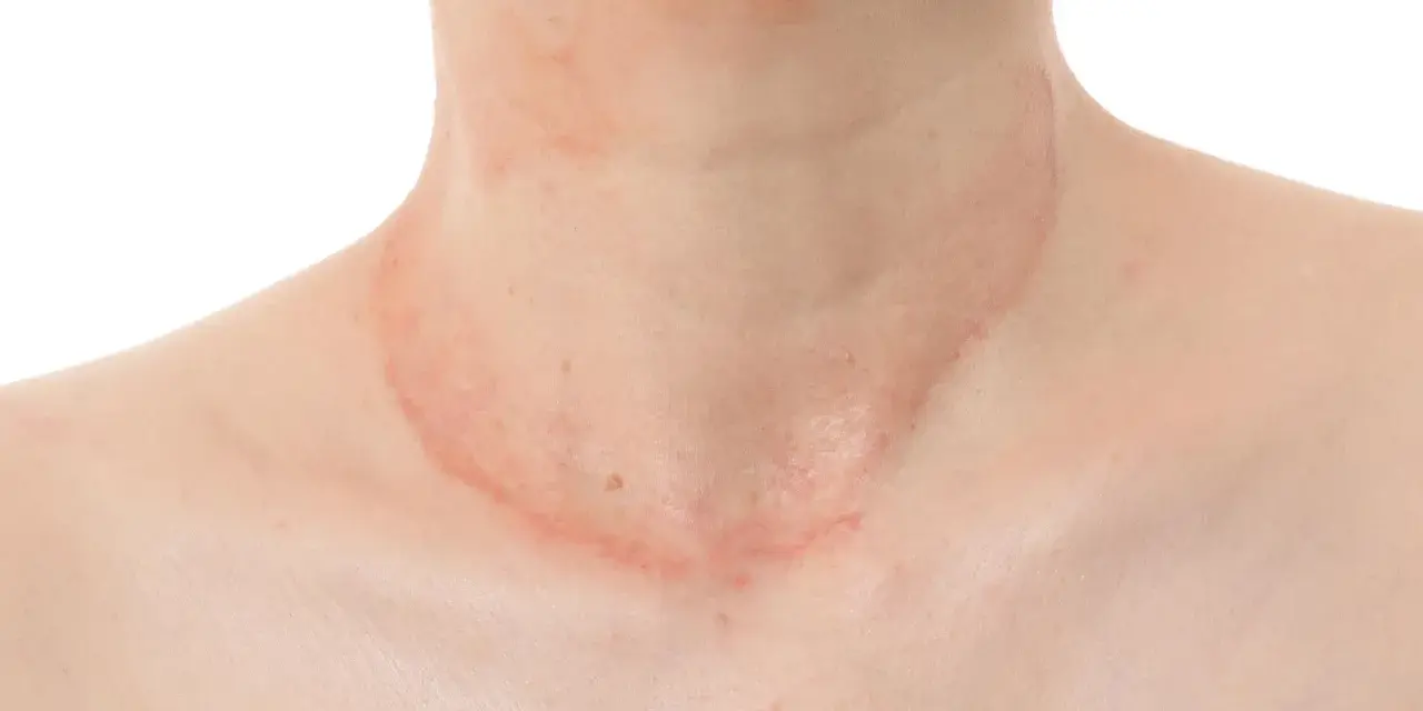 Piel con erupción rojiza y escamosa en el cuello, sugiriendo la presencia de hongos en el cuello.