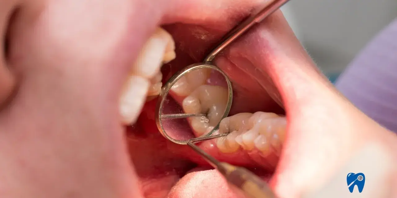 Zbliżenie na usta z widocznym zębem z ubytkiem, oglądanym przez lusterko dentystyczne.