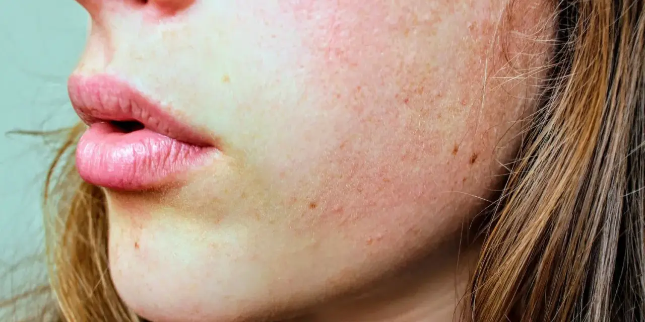 Primo piano del viso di una giovane donna con lentiggini e pelle che si squama, evidenziando una texture ruvida e secca.