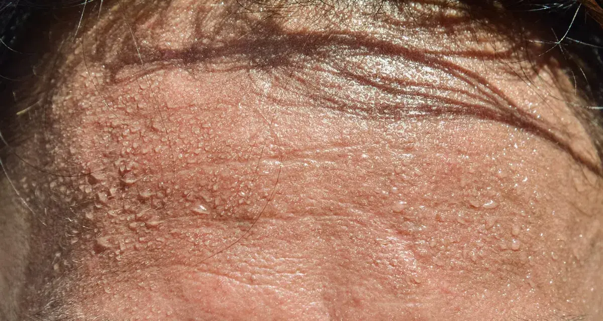 Frente sudorosa con gotas de agua. ¿Buscas trucos para no sudar por la cabeza?