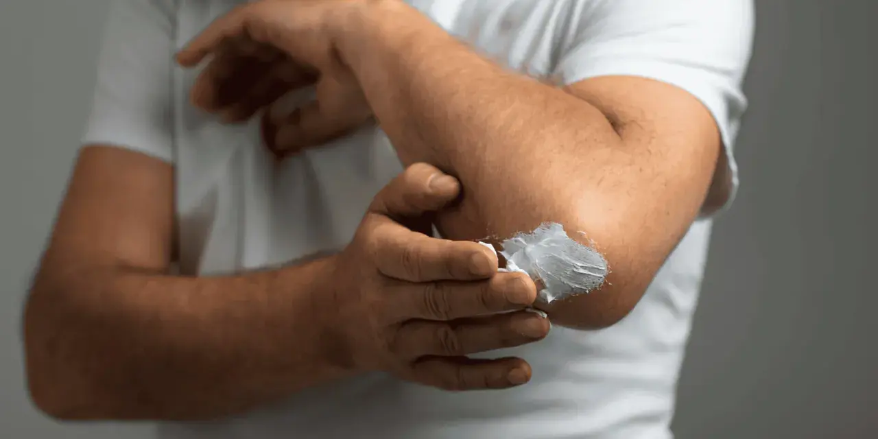 Mężczyzna smaruje łokieć kremem. Szukasz najlepszej kliniki leczenia łuszczycy?