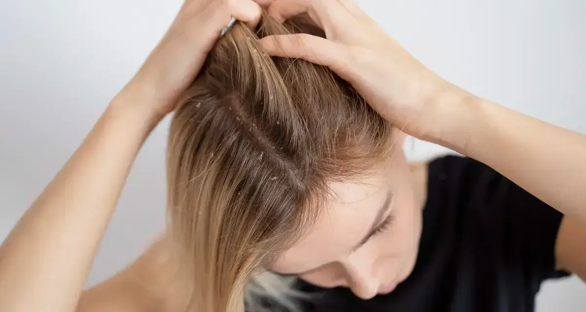 Kobieta sprawdza skórę głowy, na której widoczne są oznaki łupieżu. Czas na skuteczny peeling do włosów!