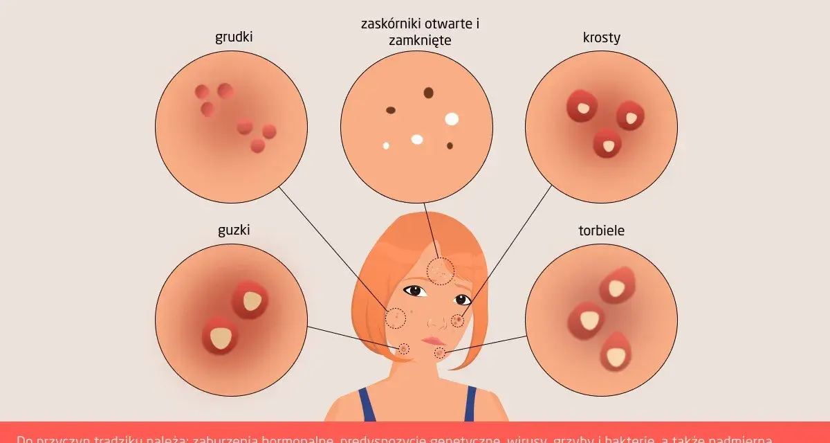 Ilustracja przedstawia różne rodzaje trądziku: grudki, zaskórniki, krosty, guzki i torbiele.